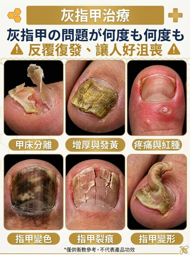 💅【SouthMoon紐西蘭蜂毒生技】蜂毒美甲修護液🔥告別厚黃灰指甲困擾|深層滲透養護指甲環境|重拾乾淨透亮美甲狀態✨ 🌿 蜂毒植萃精華配方|快速滲透指甲表層 ✨ 告別粗糙厚重感|恢復自然細緻外觀 💧 每日輕鬆塗抹|居家護理簡單方便 - 5