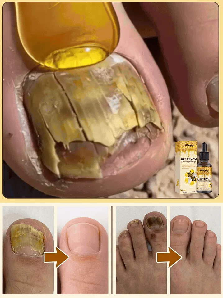 💅【SouthMoon紐西蘭蜂毒生技】蜂毒美甲修護液🔥告別厚黃灰指甲困擾|深層滲透養護指甲環境|重拾乾淨透亮美甲狀態✨ 🌿 蜂毒植萃精華配方|快速滲透指甲表層 ✨ 告別粗糙厚重感|恢復自然細緻外觀 💧 每日輕鬆塗抹|居家護理簡單方便 - 3
