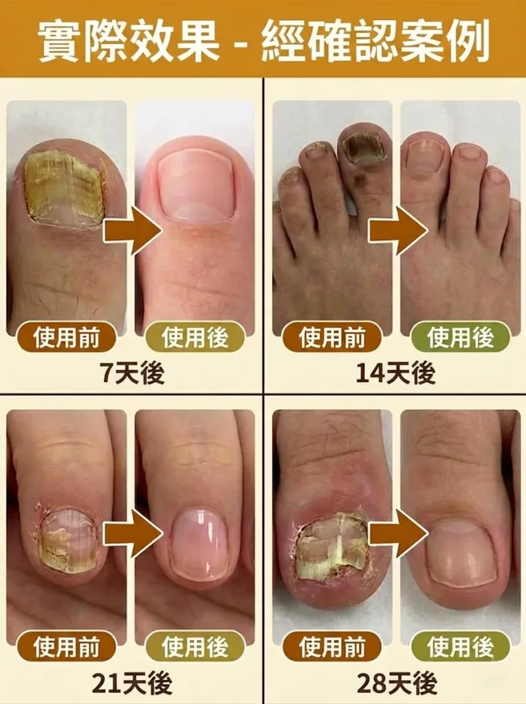 💅【SouthMoon紐西蘭蜂毒生技】蜂毒美甲修護液🔥告別厚黃灰指甲困擾|深層滲透養護指甲環境|重拾乾淨透亮美甲狀態✨ 🌿 蜂毒植萃精華配方|快速滲透指甲表層 ✨ 告別粗糙厚重感|恢復自然細緻外觀 💧 每日輕鬆塗抹|居家護理簡單方便 - 8
