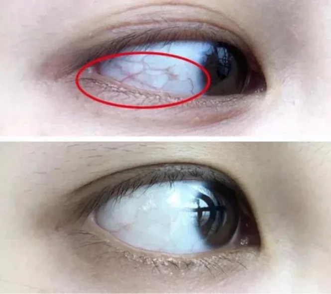 眼睛痠脹、乾澀、疲勞?醫視寳E視力眼貼:一貼舒緩,雙眼重獲清新 - 10