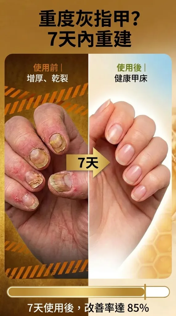 💅【SouthMoon紐西蘭蜂毒生技】蜂毒美甲修護液🔥告別厚黃灰指甲困擾|深層滲透養護指甲環境|重拾乾淨透亮美甲狀態✨ 🌿 蜂毒植萃精華配方|快速滲透指甲表層 ✨ 告別粗糙厚重感|恢復自然細緻外觀 💧 每日輕鬆塗抹|居家護理簡單方便 - 11