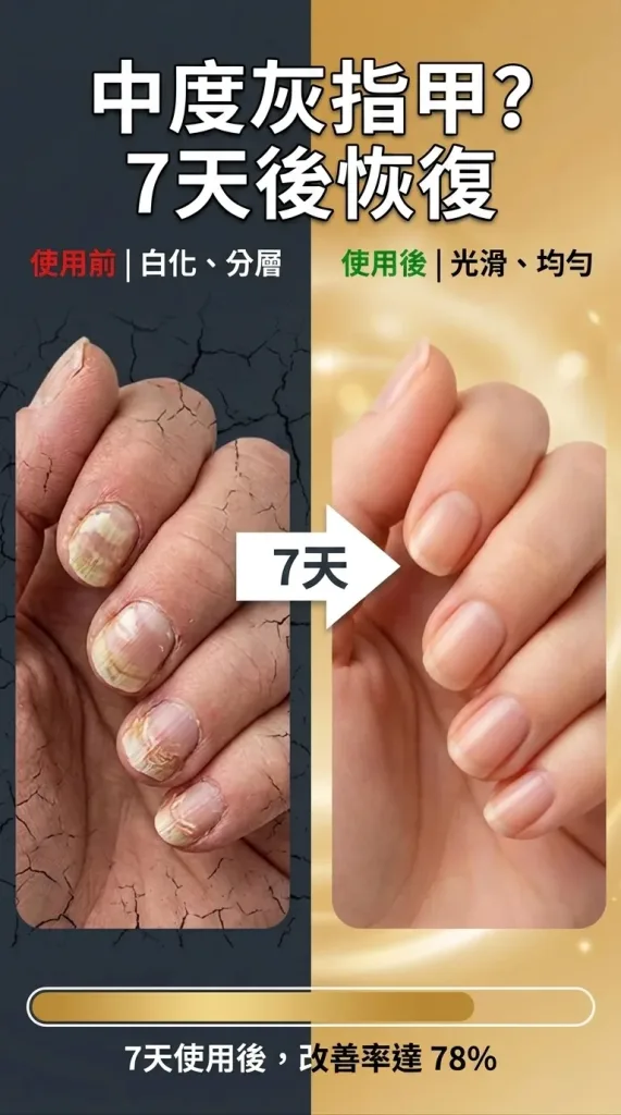 💅【SouthMoon紐西蘭蜂毒生技】蜂毒美甲修護液🔥告別厚黃灰指甲困擾|深層滲透養護指甲環境|重拾乾淨透亮美甲狀態✨ 🌿 蜂毒植萃精華配方|快速滲透指甲表層 ✨ 告別粗糙厚重感|恢復自然細緻外觀 💧 每日輕鬆塗抹|居家護理簡單方便 - 7