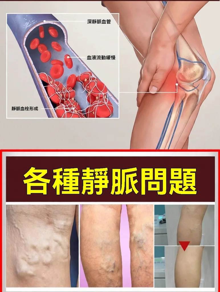 🌿【曲張脈通凝膠】植物萃取清涼護理 久站久坐後腿部容易疲憊？ 輕輕塗抹按摩 帶來清爽放鬆感 上班族 運動後 日常腿部保養好選擇 - 4